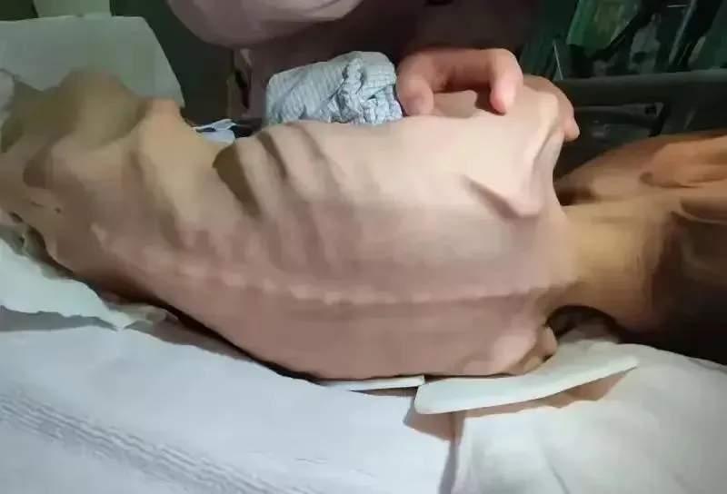 这位小男孩在短短几周内突然暴瘦,父母非常担心,无奈之下只好带他去