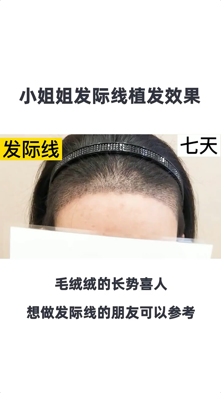 baby姐植发(植发成功案例视频)