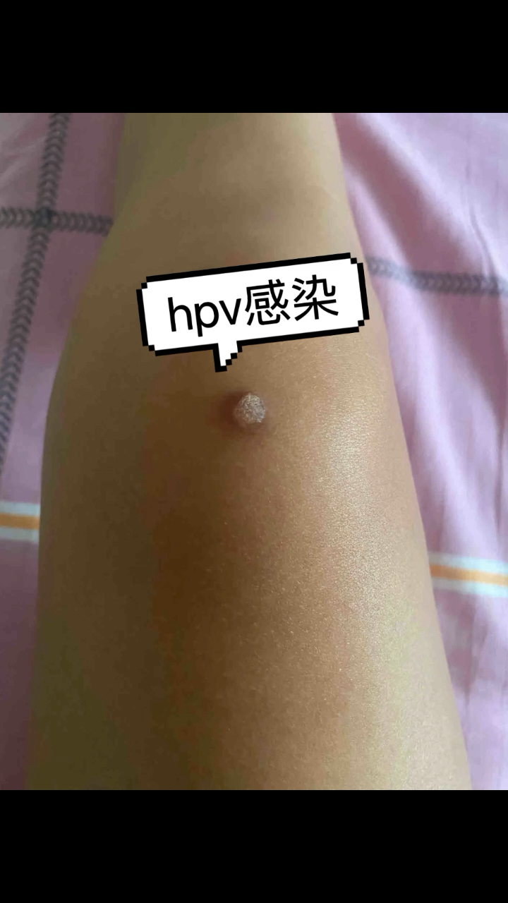 hpv感染初期,双腿或有提醒