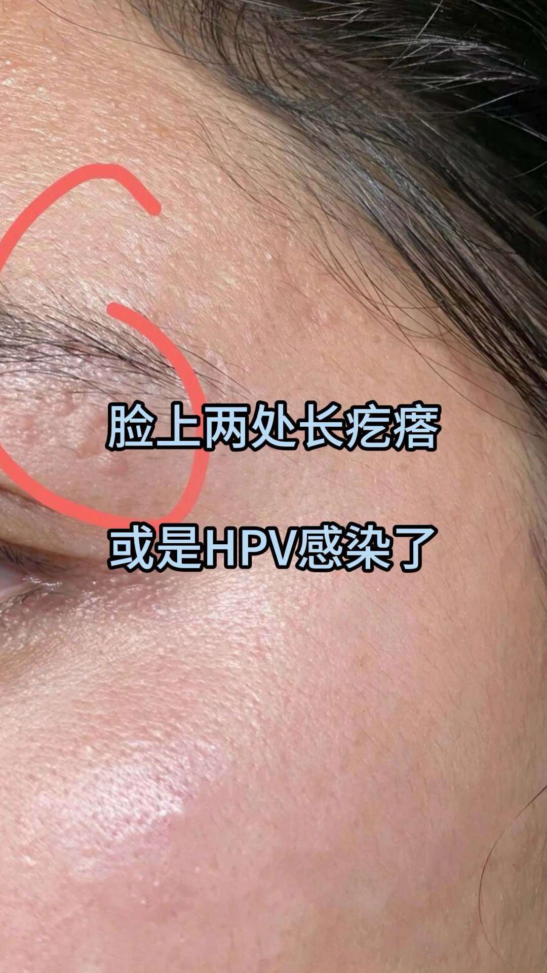 脸上两处长疙瘩,或是hpv感染了