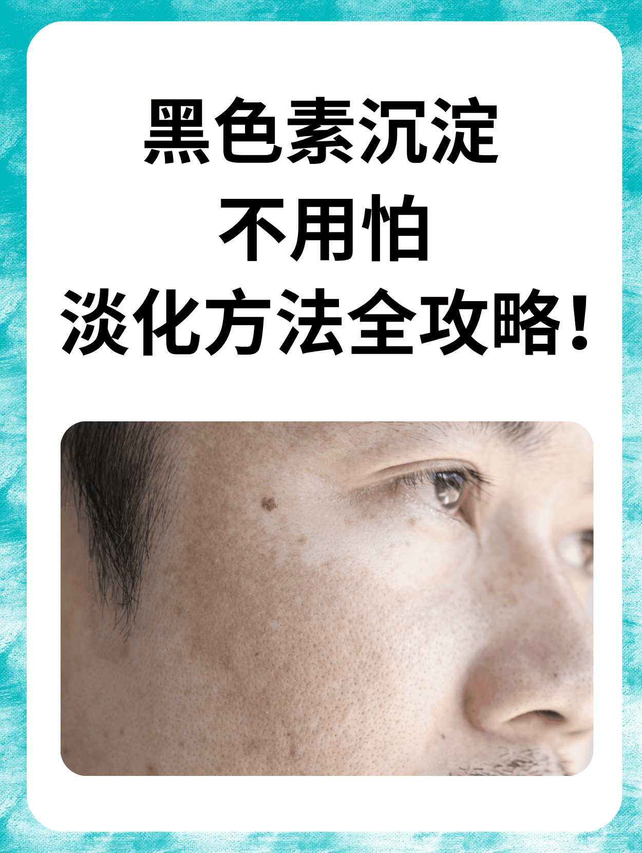 面对黑色素沉淀,是不是很多朋友都感到很困扰?
