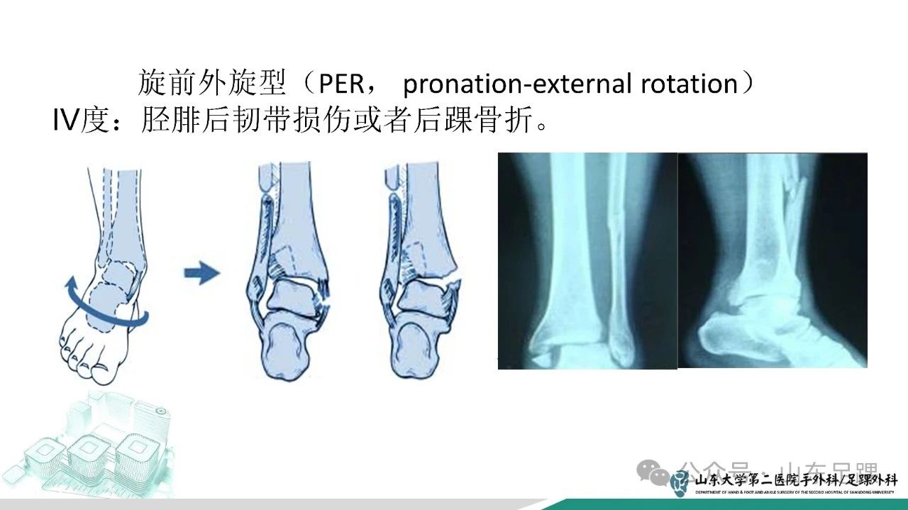 右外踝骨折片子图解图片