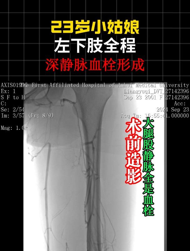 23岁小姑娘左下肢全程深静脉血栓形成