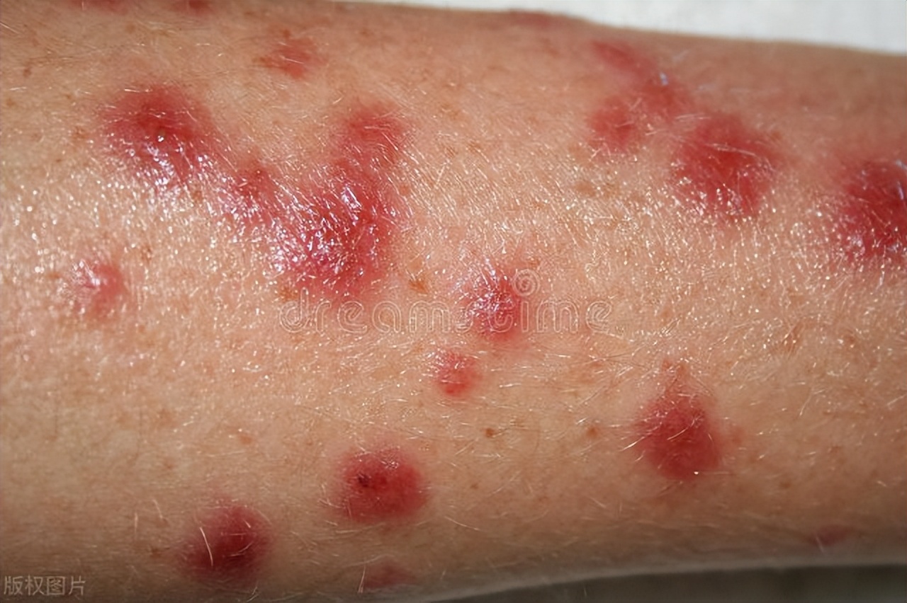 身体这3处变红,或是胰腺癌"警报"?千万别忽视,建议抓紧自查