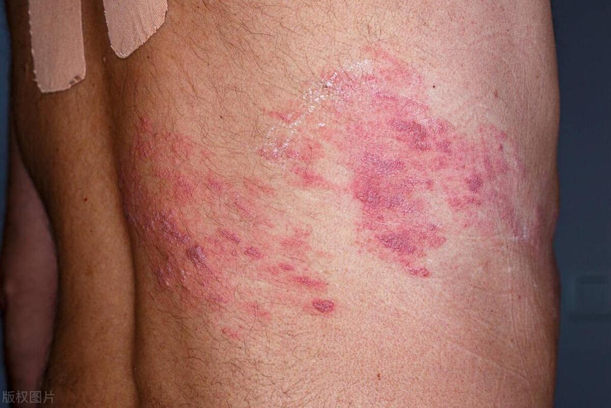 身体这3处变红,或是胰腺癌"警报"?千万别忽视,建议抓紧自查