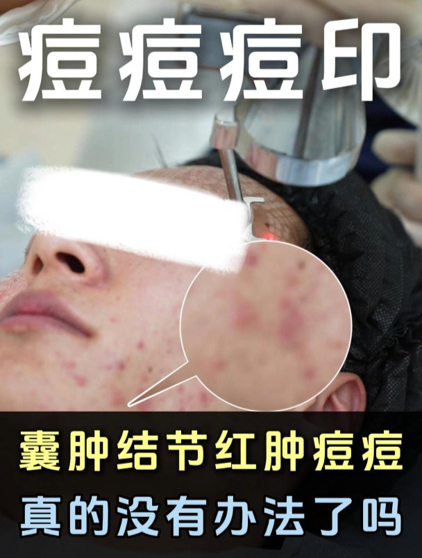 囊肿结节红肿痘痘,真的没有办法了吗?