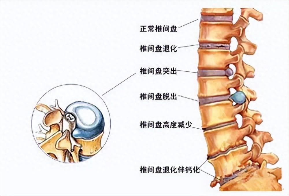 体表位置示意图腰1椎体前上缘的位置图腰2椎体腰突的本质是能量淤堵