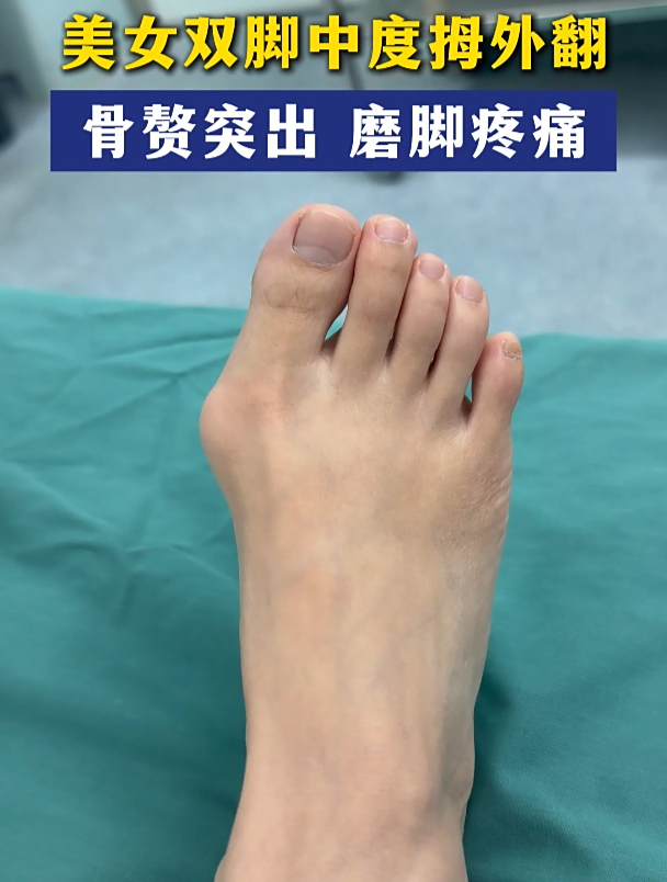 美女的不完美 双脚中度拇外翻,骨赘突出 磨脚疼痛