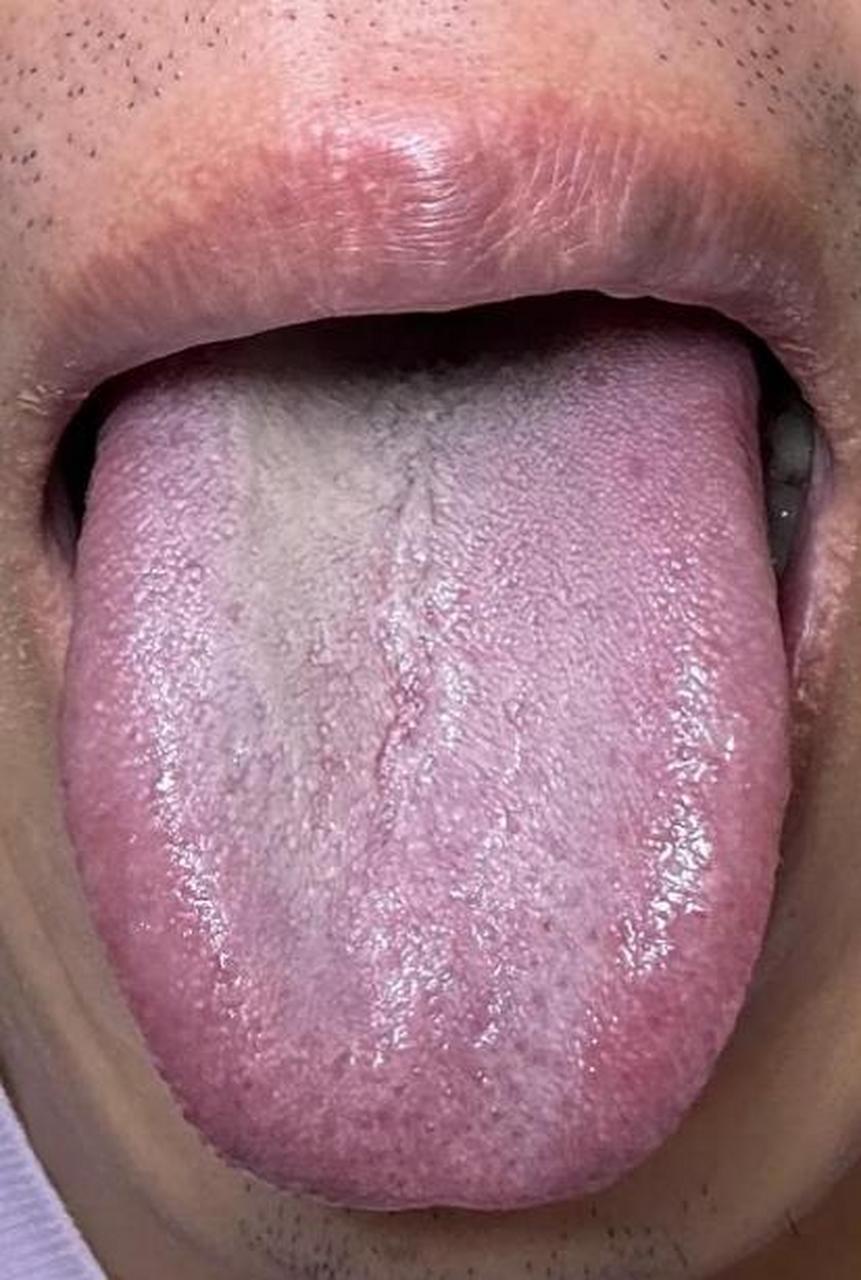 小伙子吃泻火药,补药都不见效,一瞧他的舌头,真是让人大吃一惊!