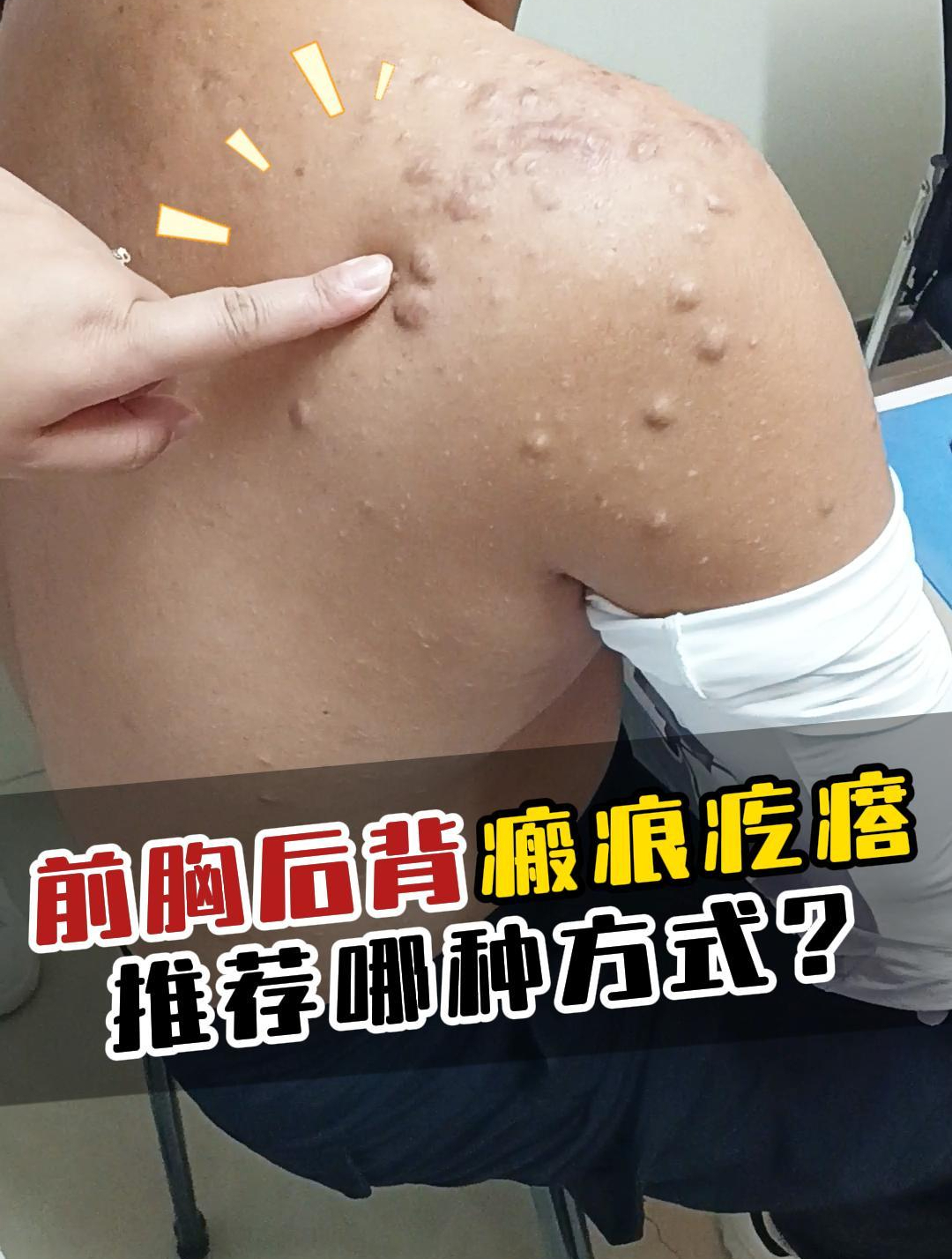前胸后背瘢痕疙瘩,治疗方式怎么选?