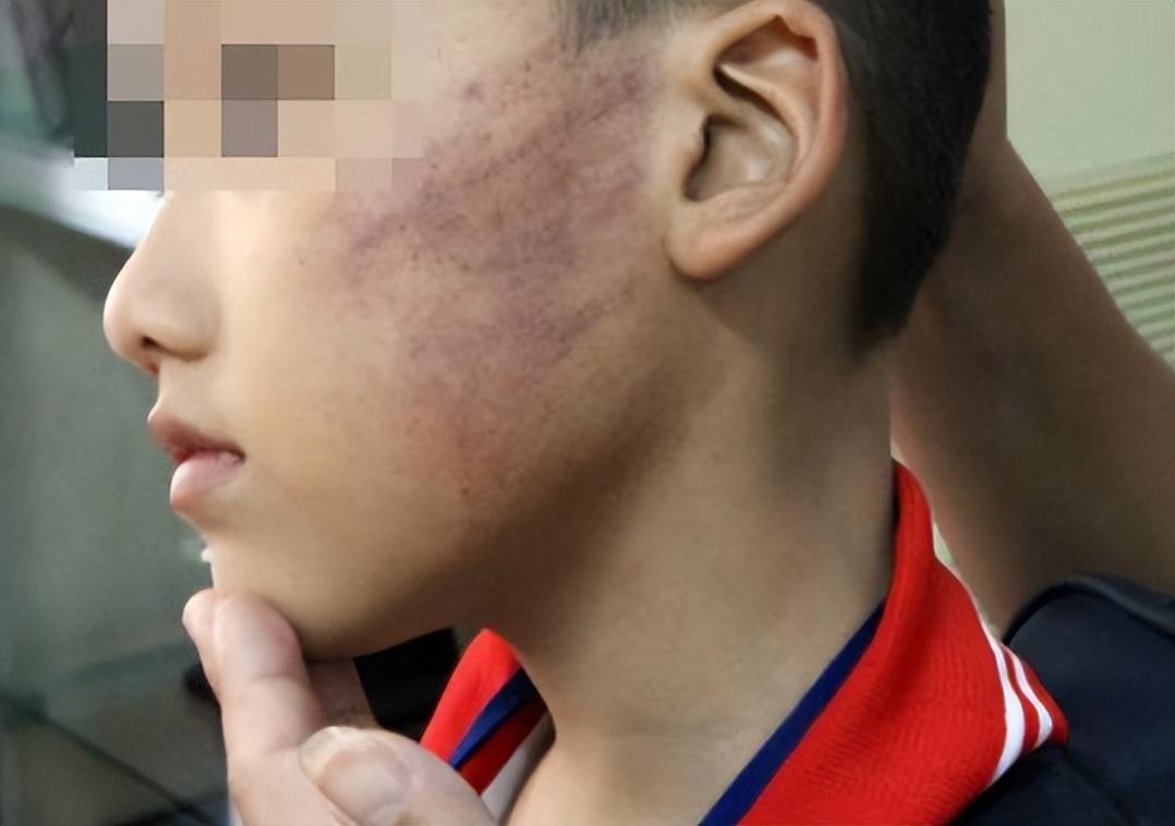儿子被同学抽15个耳光,癌症晚期的我选择以暴制暴,拉他们陪葬!