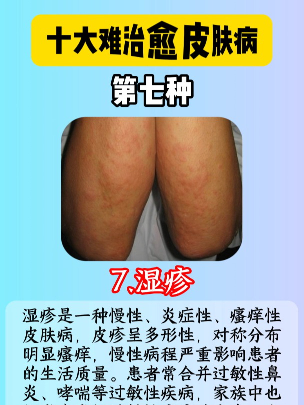 最难治疗的10种皮肤病