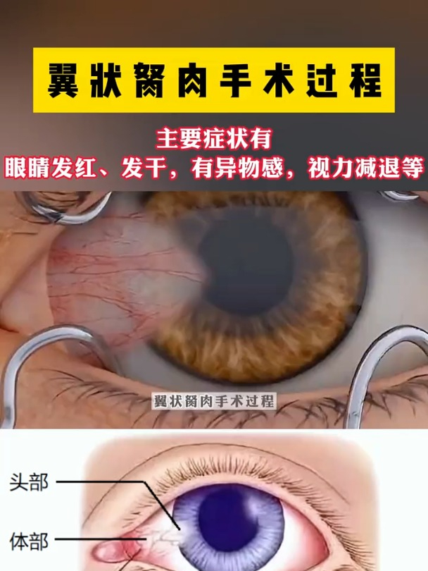 翼状胬肉手术过程!