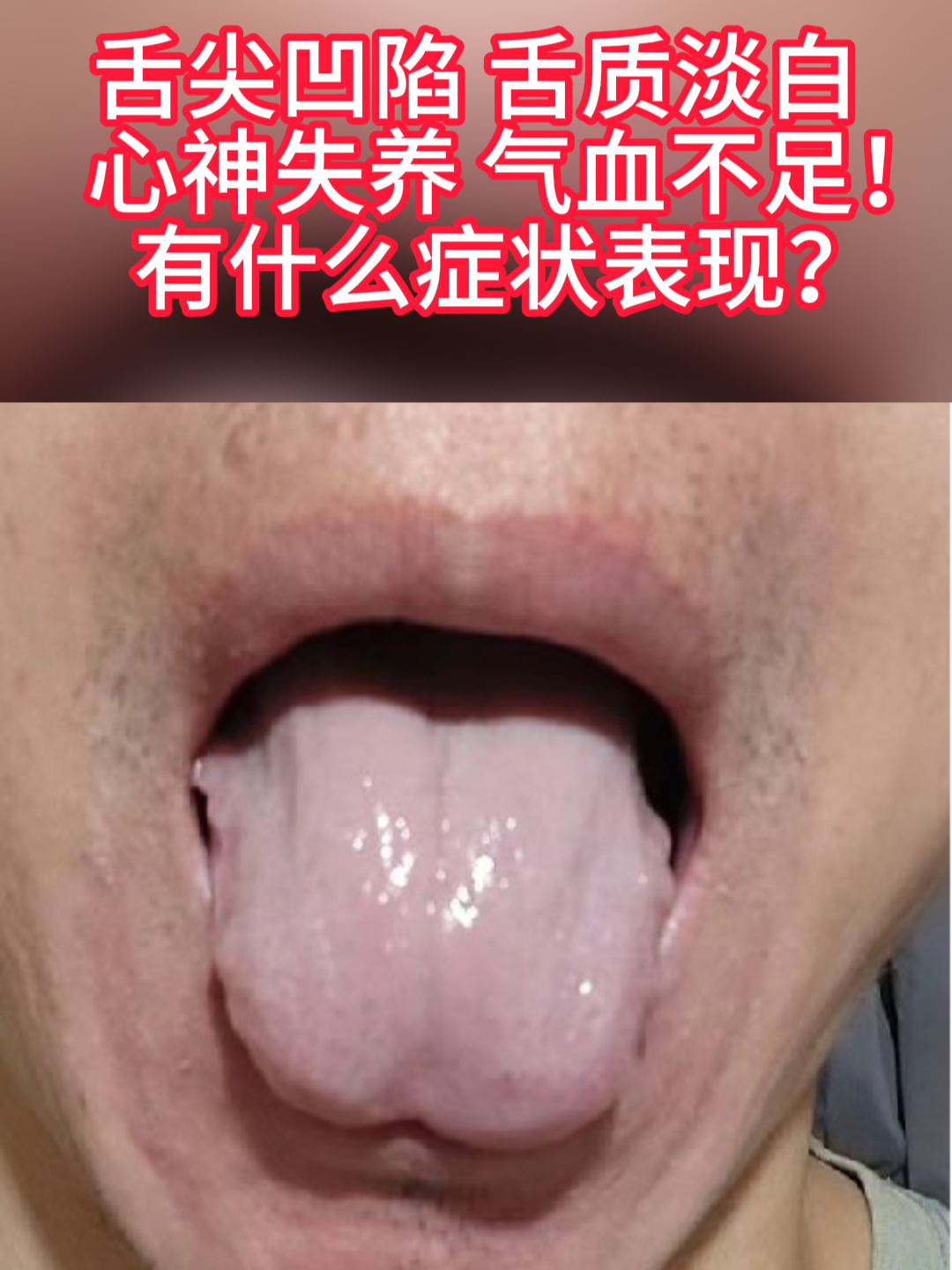 舌尖凹陷,舌质淡白,心神失养,气血不足!有什么症状表现?