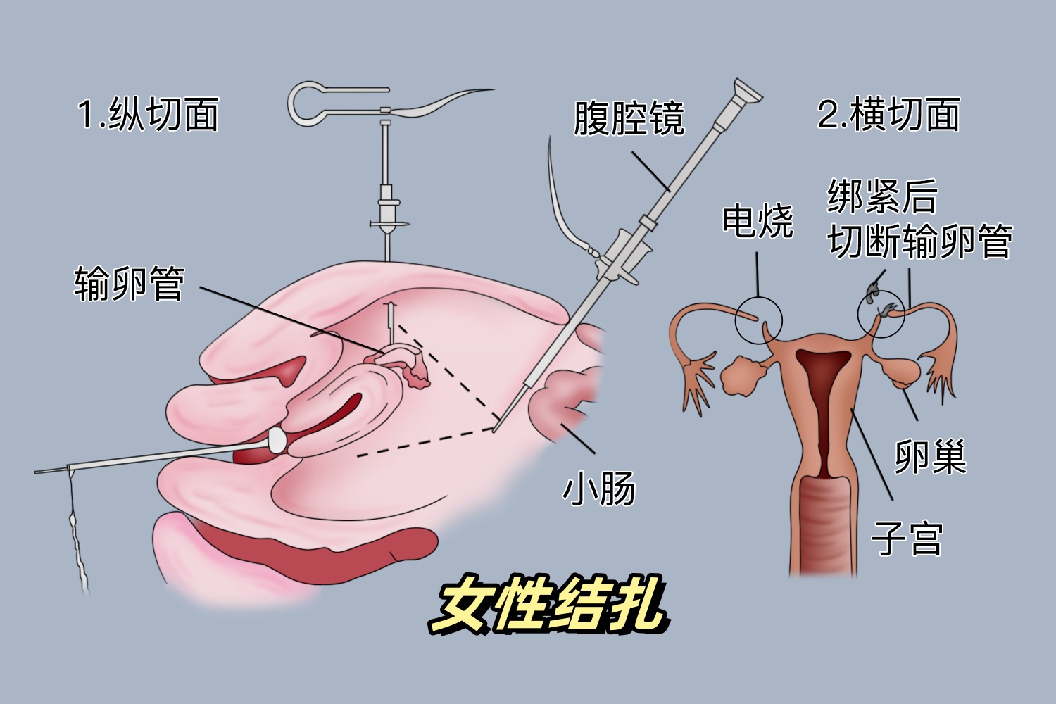 不打算生娃了,是结扎还是带环呢?这种避孕方式,更受女性青睐