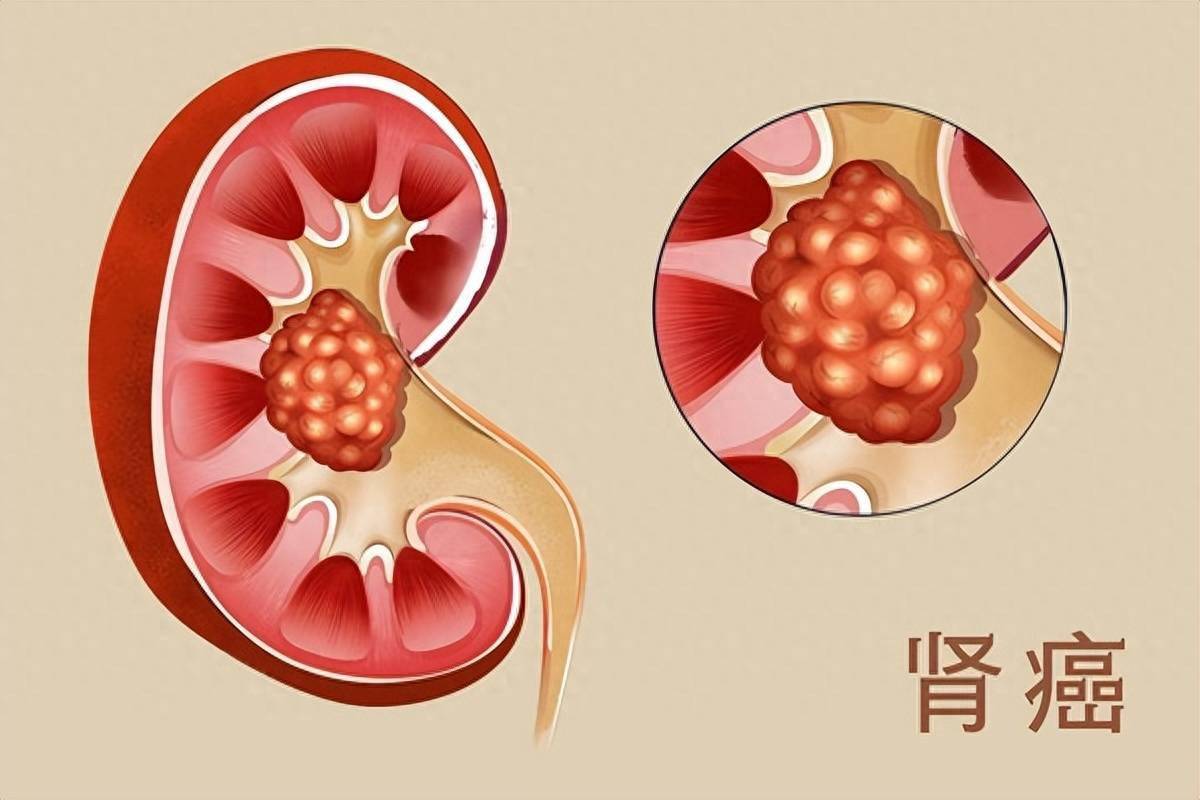 人工肾工作原理图图片