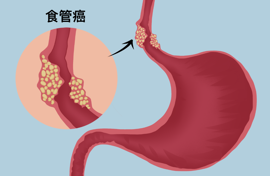 湖北44岁大姐不到1年就食道癌复发