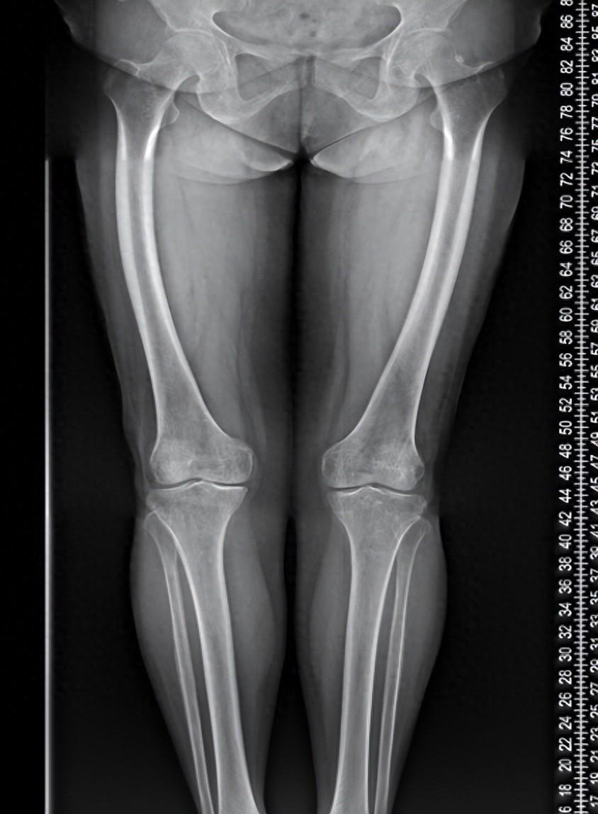 膝关节单髁置换术助74岁高龄老人重获行走自由