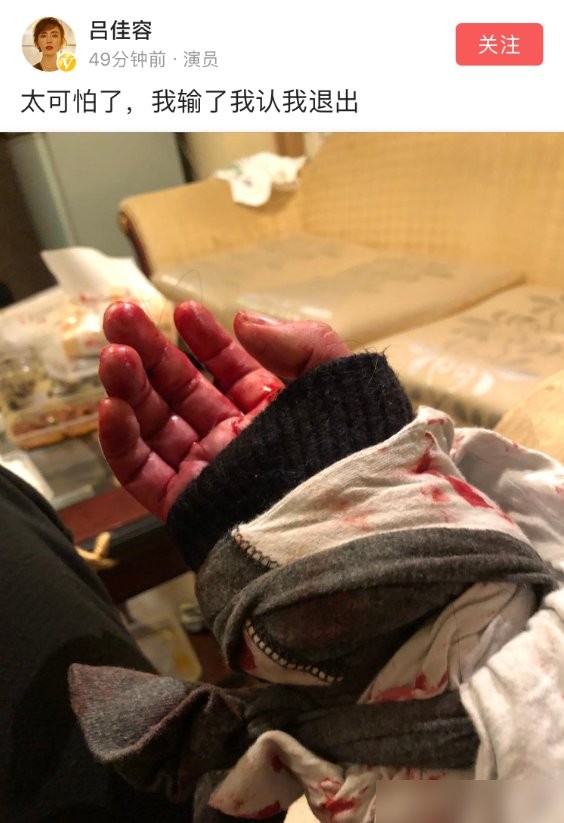 传演员吕佳容出事,曾晒割腕"自残"照,称若出事就像乔任梁一样