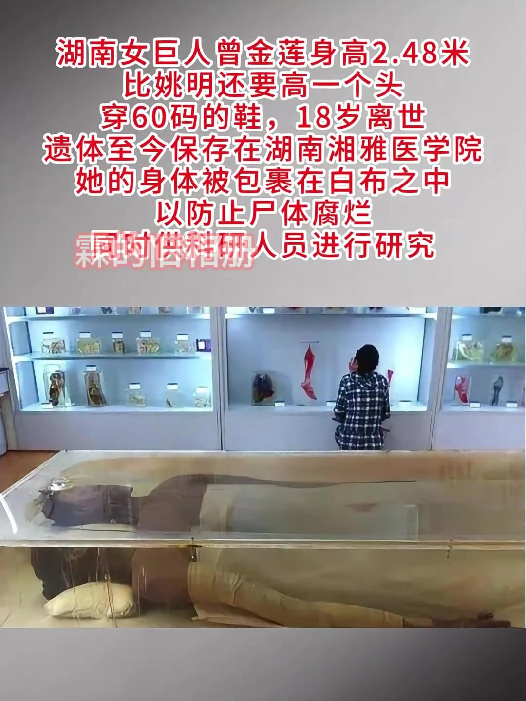 湖南女巨人身高2.48米,20岁睡梦中去世,遗体封存