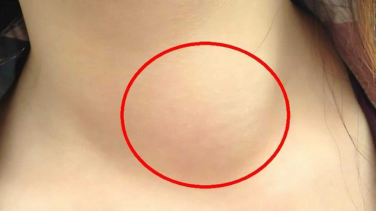 女子手术成功后服用优甲乐,复查后医生叹息:珍惜生活吧