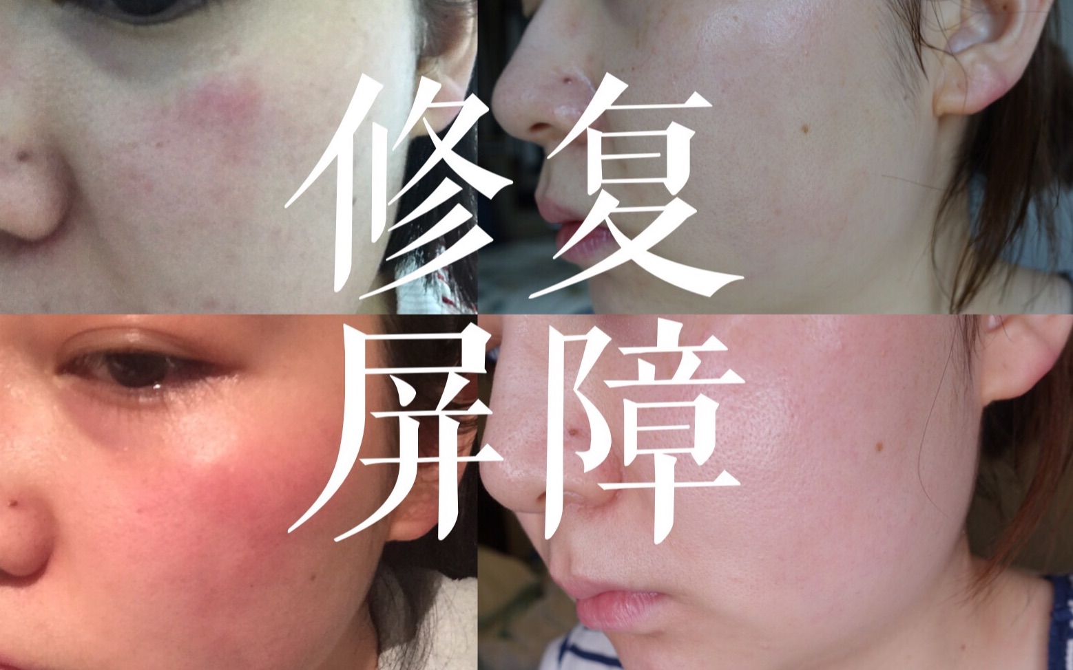 皮肤屏障受损,应该如何修复?