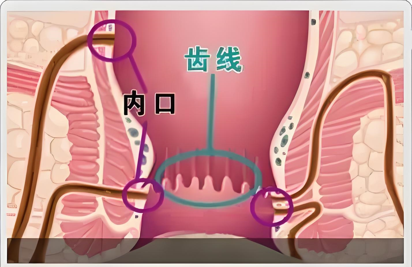 肛瘘长在什么位置图片图片