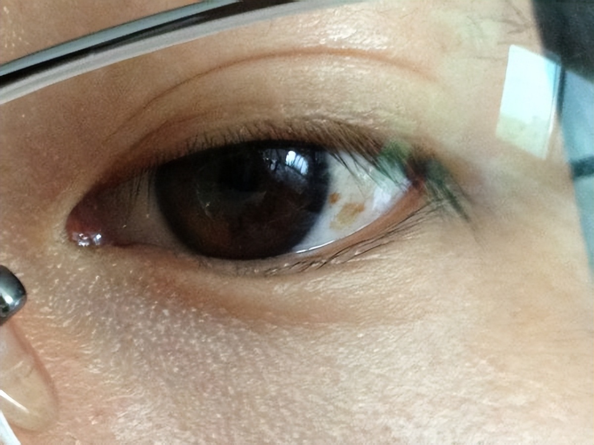 出现这些症状,你的视网膜在呼救!做好3个预防,远离视网膜脱离