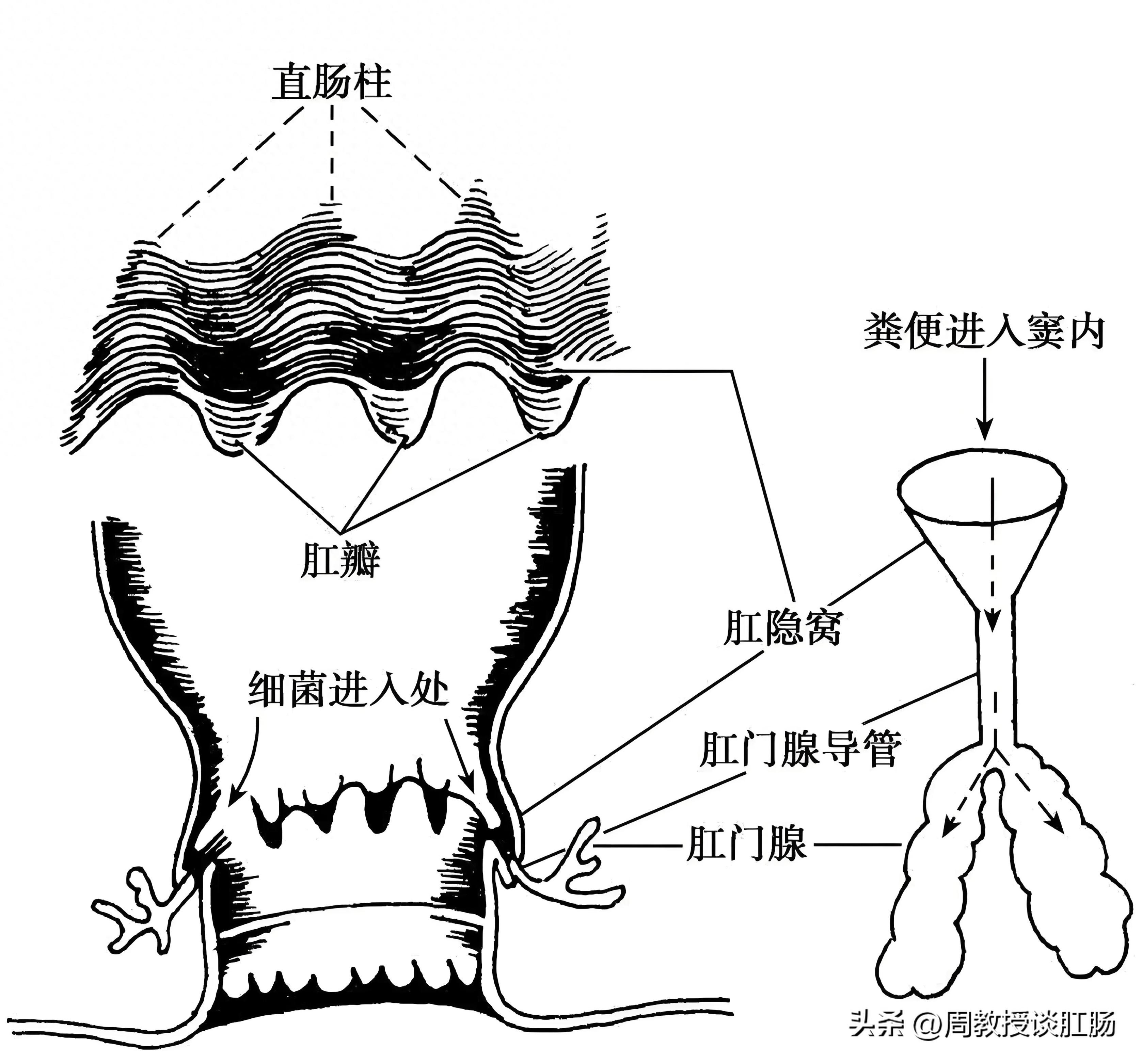 肛周脓肿手术示意图图片