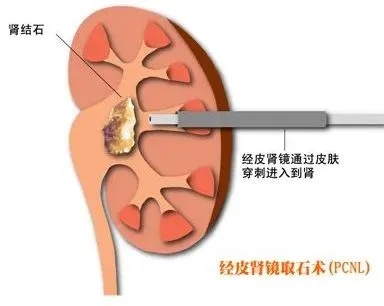 新化结石技术‖ 经皮肾镜狄激光碎石,实现巨大肾结石"零残留"