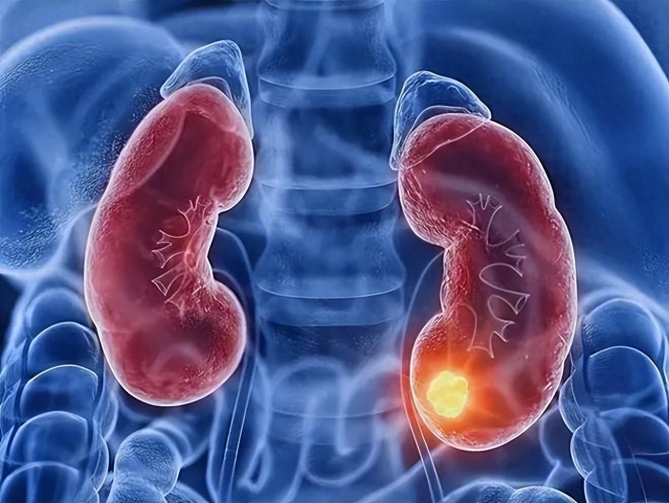 常见的肾脏疾病有哪些?肾脏有问题会出现哪些症状?如何预防?