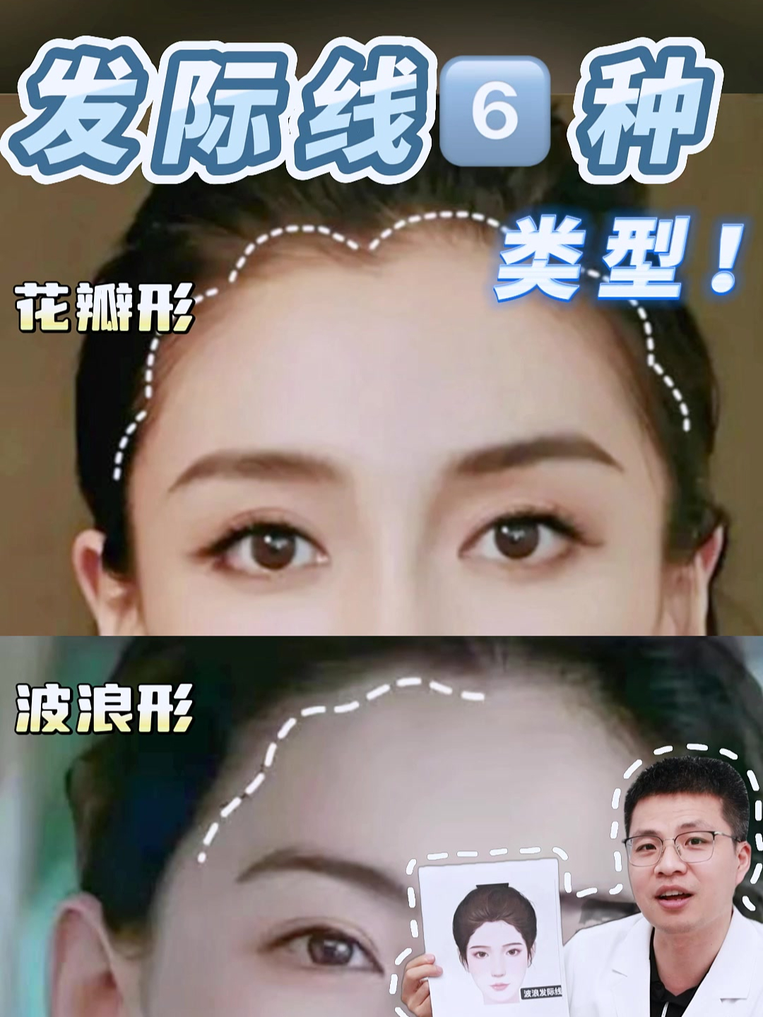 6种不同类型发际线,看看你是哪一种?