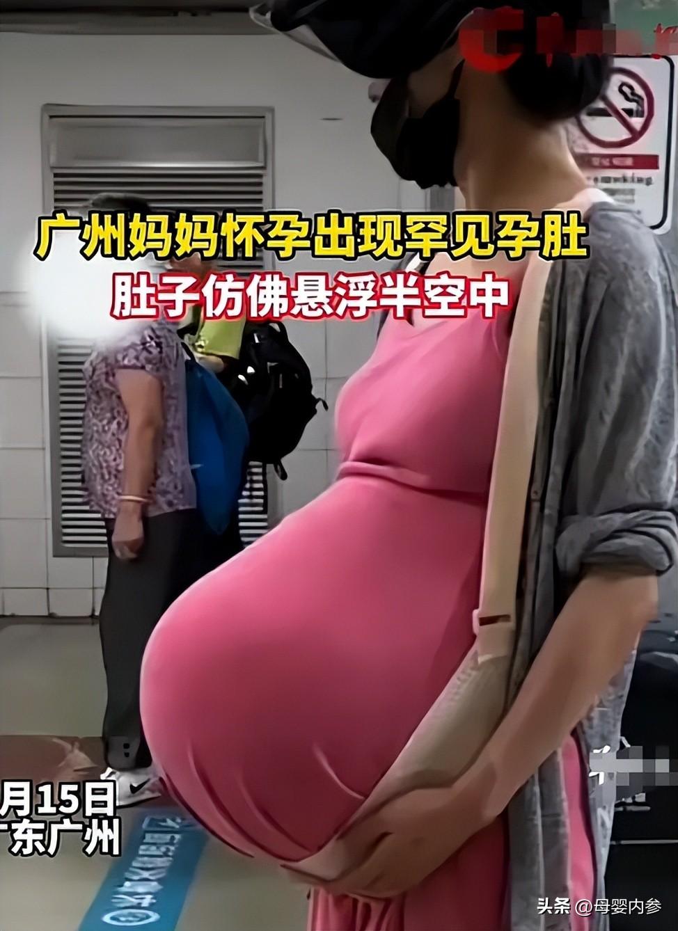 双胎孕妈"悬浮肚"像假怀孕,背看轻盈如少女,肚子像放了个西瓜