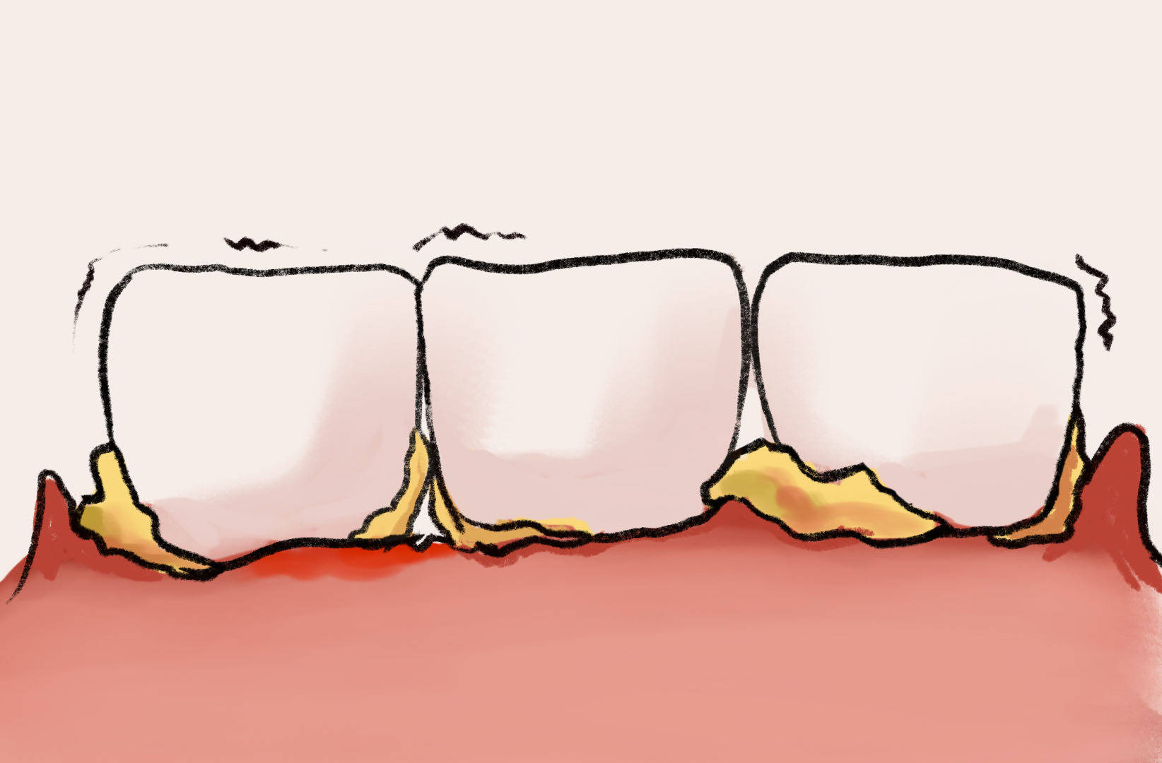 29岁女子牙结石张嘴就尴尬,医生:预防牙结石,做好这些事