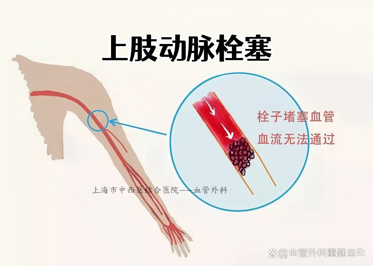 上肢动脉血管闭塞症