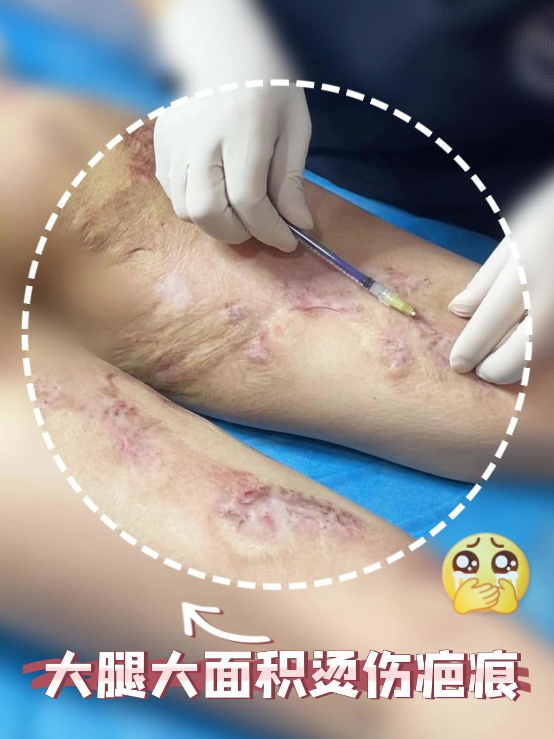 女孩大腿,被开水烫伤,2次修复结果很欣慰
