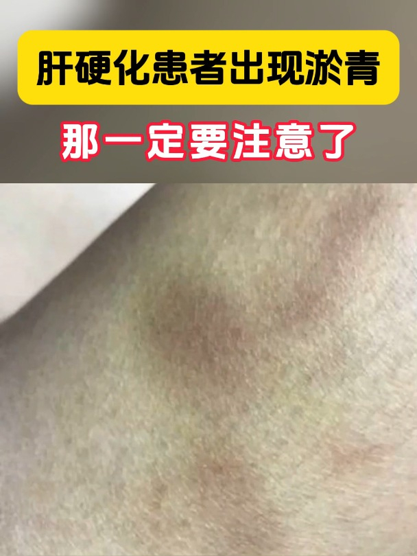 肝硬化患者出现淤青是什么原因