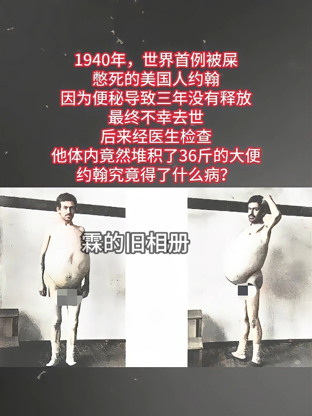 巨结肠照片图片