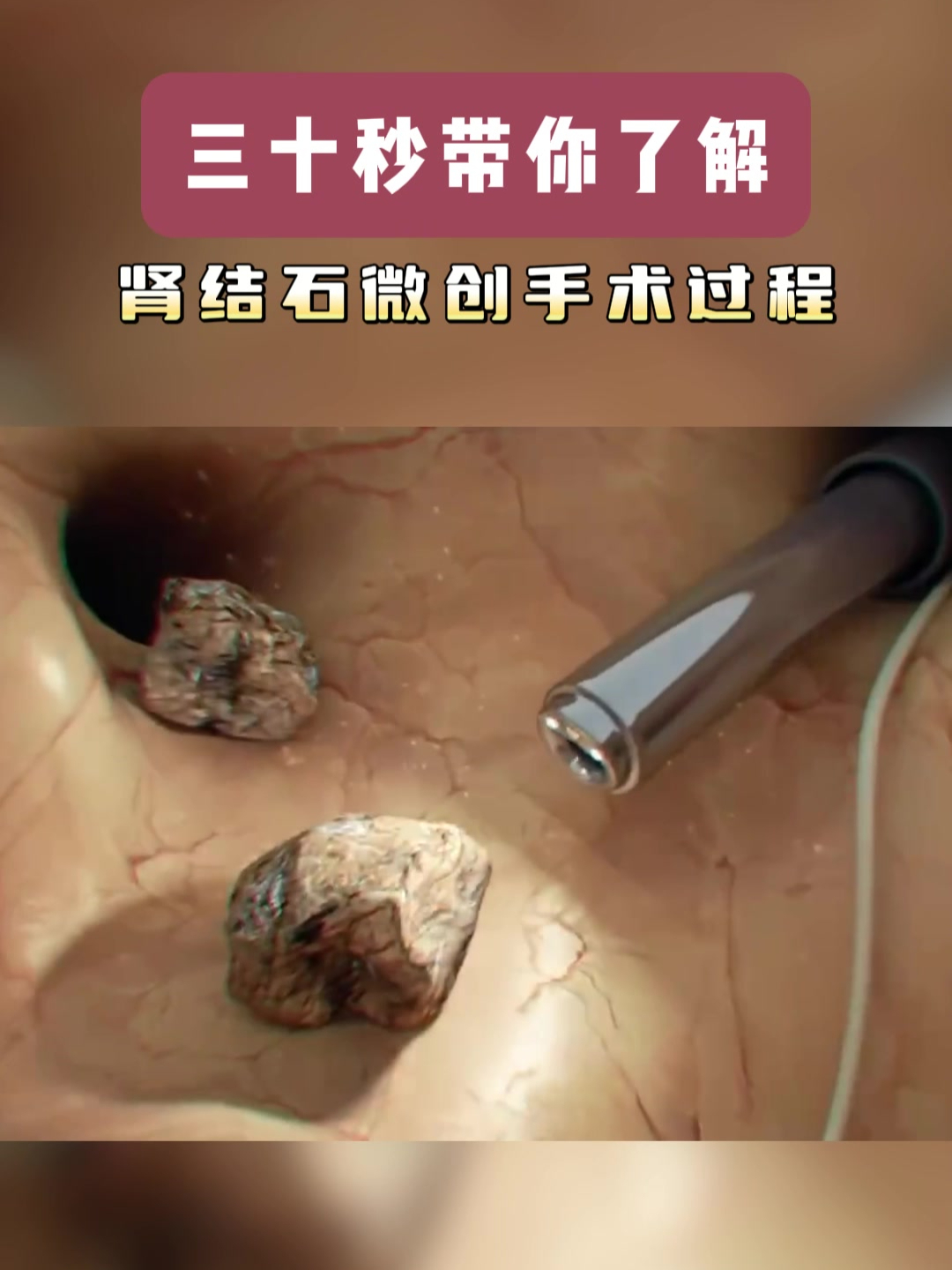 三十秒带你了解肾结石微创手术过程