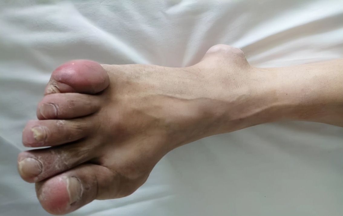 13年,42岁男子患痛风,坚持吃苯溴马隆降尿酸,1年后身体怎样了