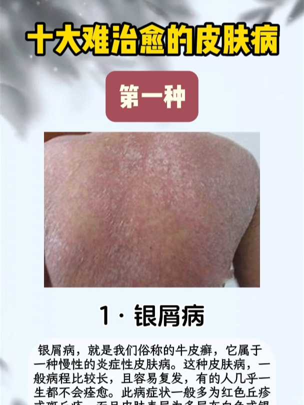 最难治疗的10种皮肤病