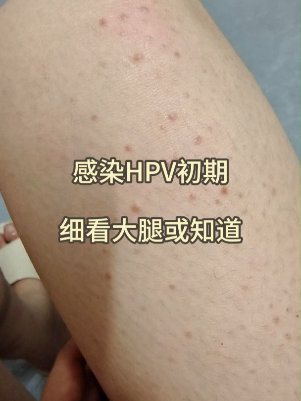 hpv感染早期图片女性图片