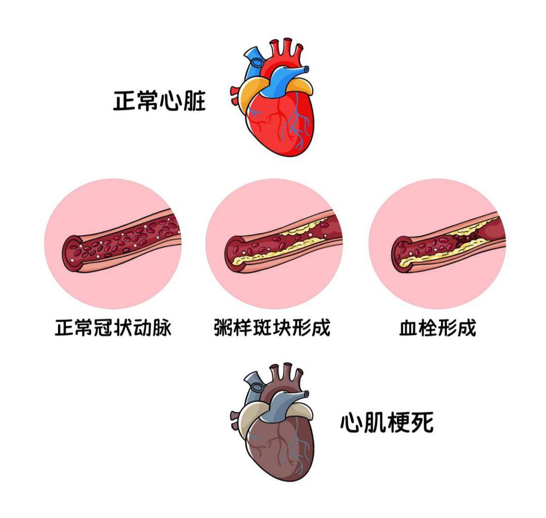 冠状动脉球囊扩张图片