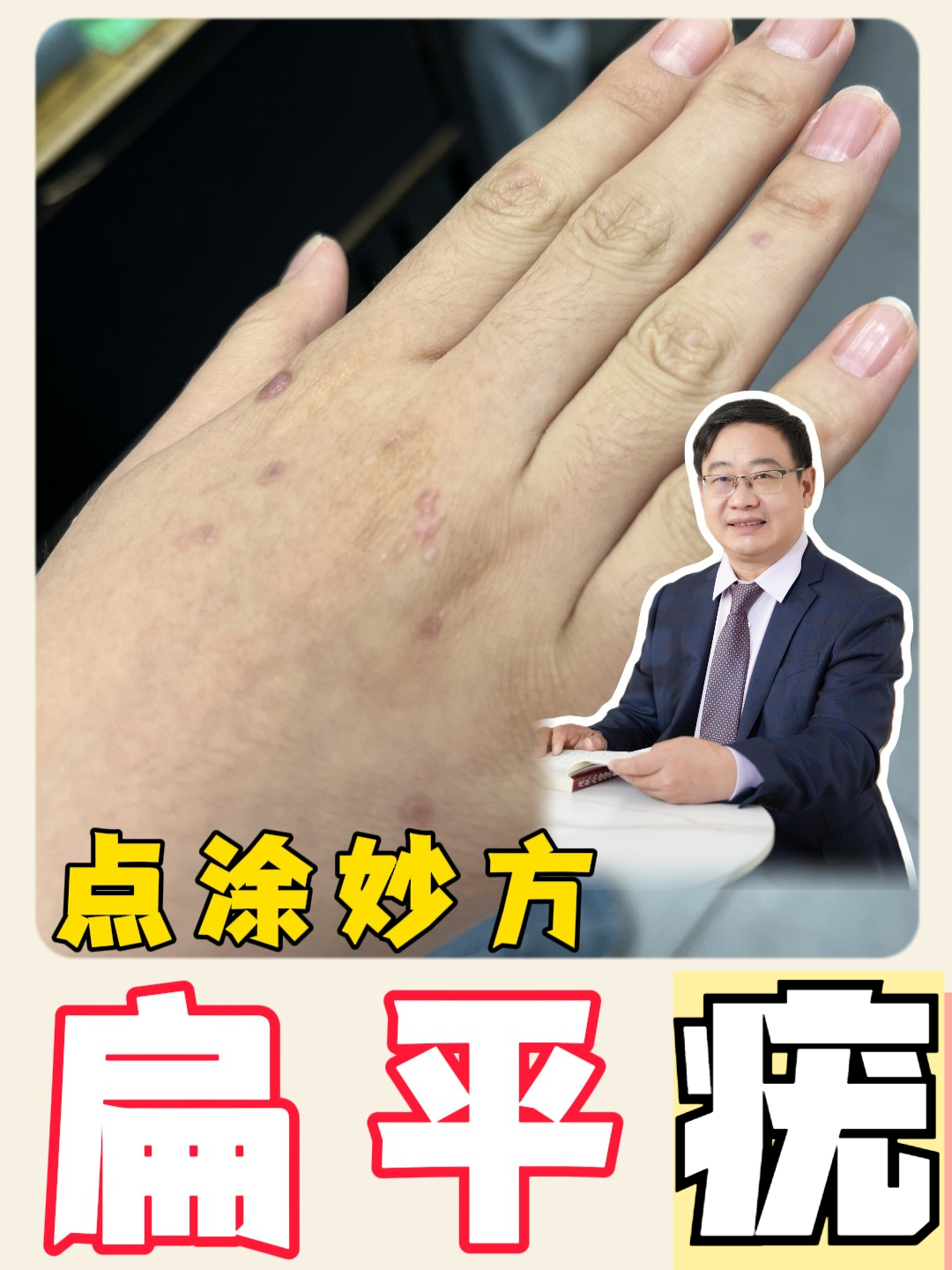 扁平疣点涂妙方,巧治扁平疣