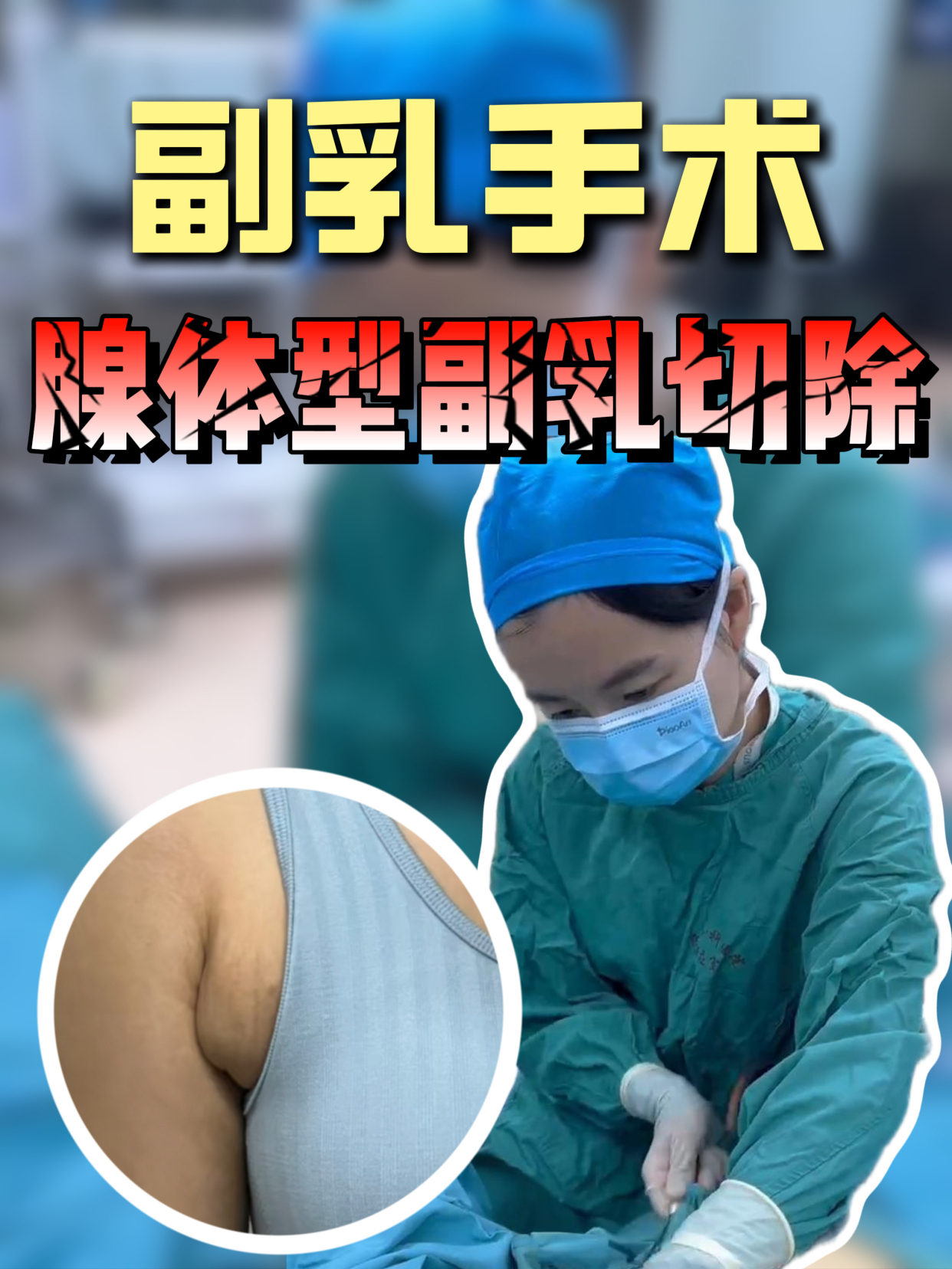 30岁女性腺体型副乳切除手术全过程