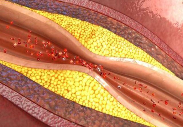 血管斑块图示图片