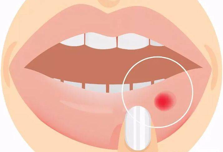 口腔溃疡疼图片卡通图片