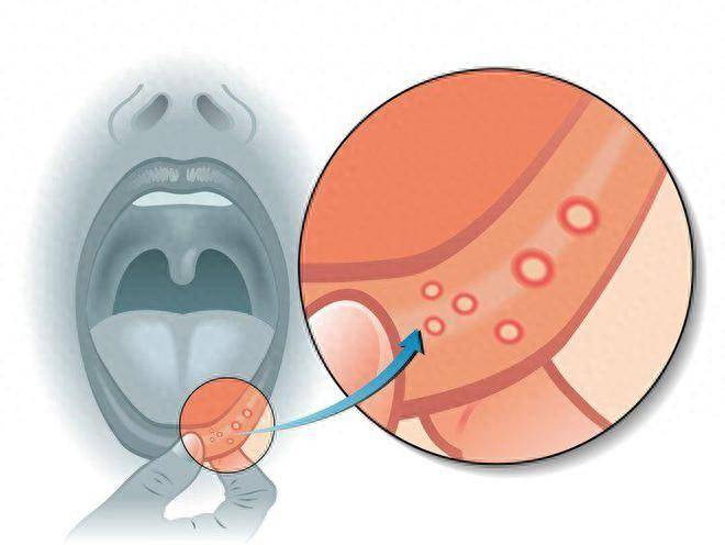 口腔溃疡形成图片