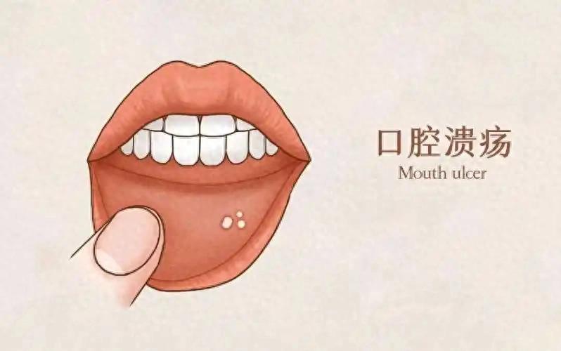 为什么容易长口腔溃疡