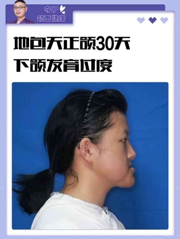 下颌发育过渡,地包天正颌术后30天分享